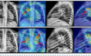 Un sistema basado en IA facilita la detección de tuberculosis en niños