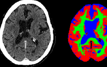 Nuevas vías para investigar el alzhéimer en personas con síndrome de Down