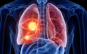 El ejercicio físico mejora la calidad de vida en pacientes con cáncer de pulmón